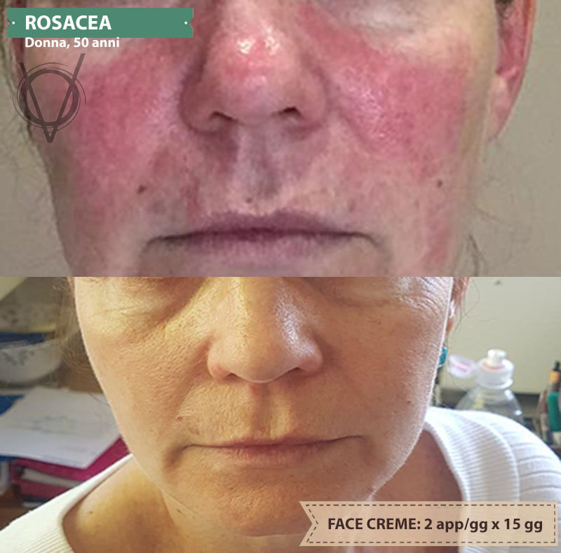 rosacea 