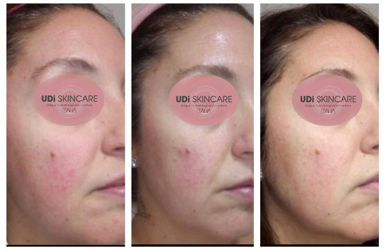 rosacea 